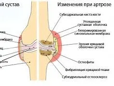 як лікувати артроз колінного суглоба в домашніх умовах