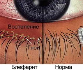 лікування блефарити століття