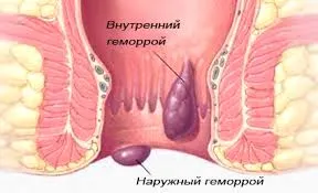 вилікувати геморой на ранній стадії