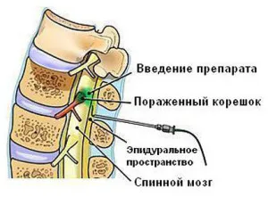 як лікувати остеохондроз медикаментозно