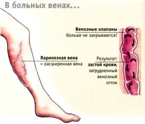 лікування варикозу без операції