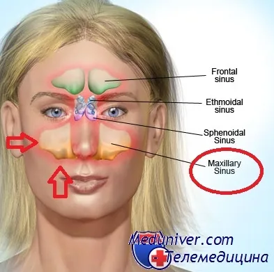 механізми розвитку гаймориту