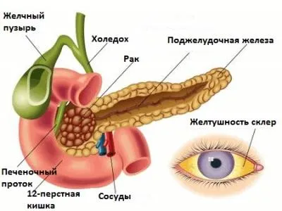 лікування механічної жовтяниці за кордоном