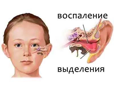 як лікувати отит зовнішнього вуха
