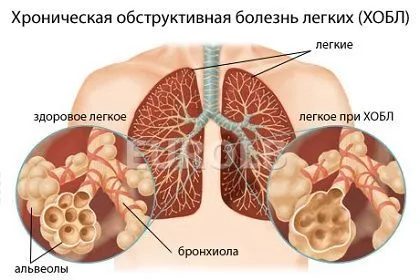 ХОЗЛ загострення легкі бронхи