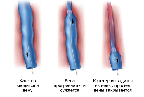як лікувати варикоз без операції