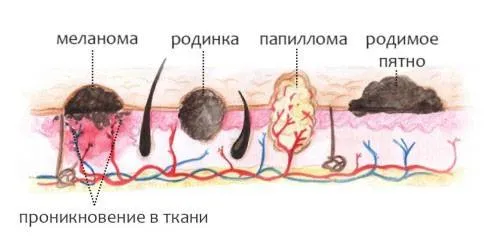 як вивести папіломи яйцем
