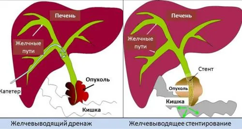 механічна жовтяниця при раку