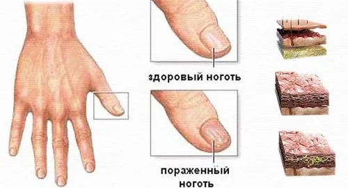 як вилікувати нігті вдома