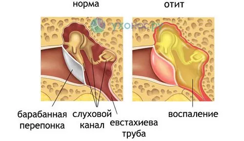 як швидко вилікувати отит в домашніх умовах