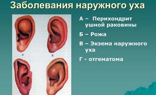 екзема у вухах