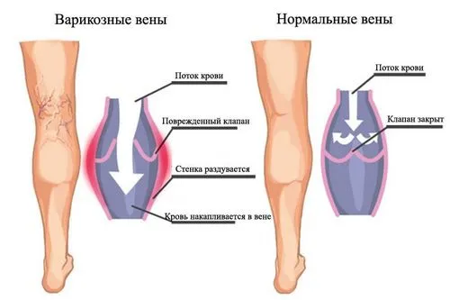 як лікувати варикоз вен ніг будинку