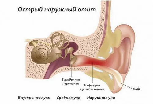 як лікувати ангіну і отит