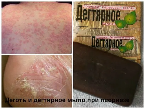 Лікуємо псоріаз в домашніх умовах як лікувати псоріаз шкіри