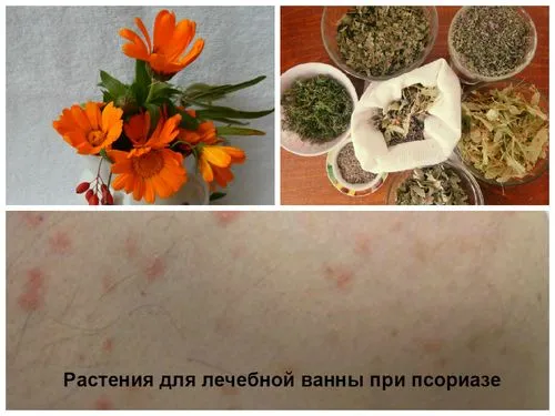 Лікуємо псоріаз в домашніх умовах як лікувати псоріаз шкіри
