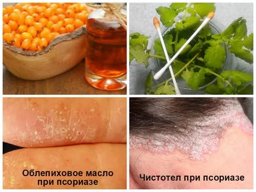 Лікуємо псоріаз в домашніх умовах як лікувати псоріаз шкіри