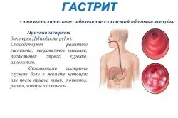 Масло обліпихи при гастриті як лікувати шлунок обліпихою