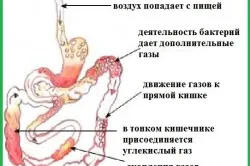 як лікувати газовий живіт