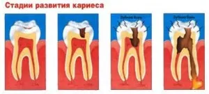 Гострий карієс гострий карієс лікування зуб