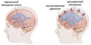 Підвищений внутрішньочерепний тиск: симптоми, лікування, ознаки, причини лікування
