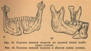 як лікувати забій нижньої щелепи