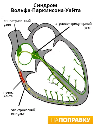 тахікардія