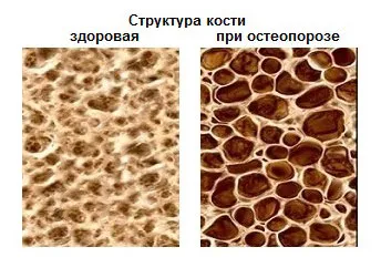 харчування при остеопорозі хребта