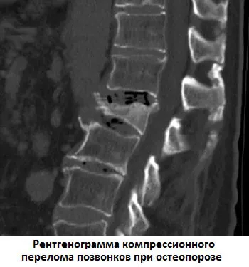 остеопороз хребта симптоми і лікування