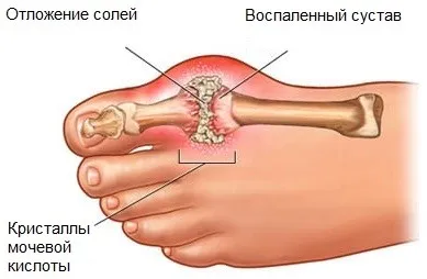 як лікувати опухлі суглоби рук