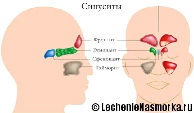 як лікувати гнійний синусит