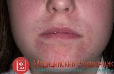 як лікувати дерматит під носом