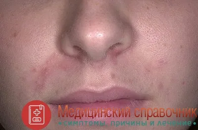як лікувати дерматит під носом