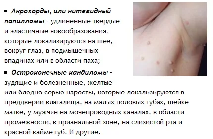 як лікувати папіломи вірусна інфекція