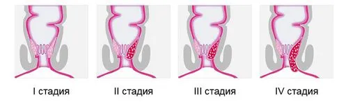 гострий геморой