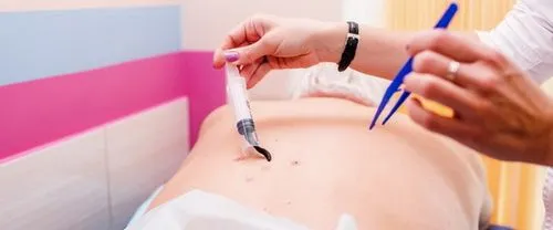 лікувати ендометріоз п'явками