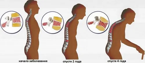 симптоми остеопорозу хребта