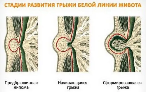 як лікувати жировик на животі