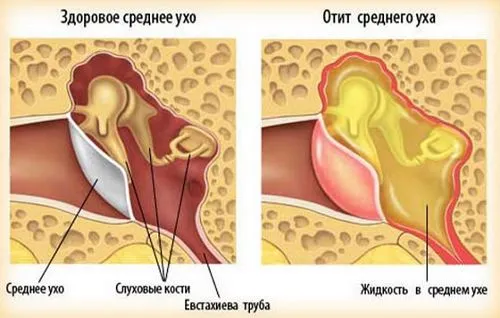 як лікувати інфекційний отит
