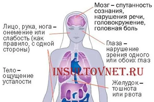як лікувати правобічний інсульт