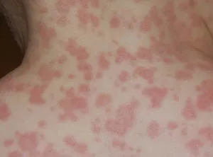 Alergia la amoxicilină (amoxicilină) Alergia la amoxicilină