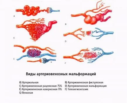 malformație arterio-cauze, simptome și tratament