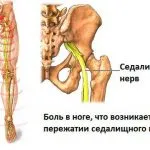 як лікувати невралгію сідничного нерва