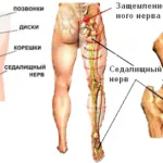 як лікувати невралгію сідничного нерва