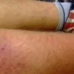 як лікувати пику антибіотиками