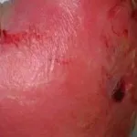 як лікувати пику антибіотиками