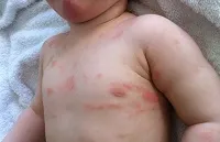 як лікувати дитячий псоріаз
