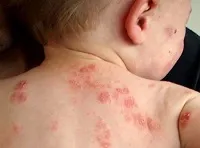 як лікувати дитячий псоріаз