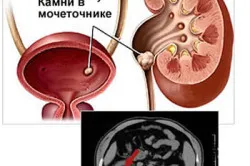 як лікувати мочесолевой діатез