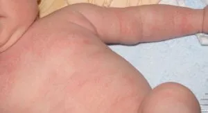як лікувати дитячий псоріаз