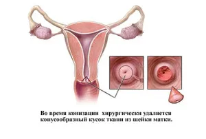 як лікувати рак шийки матки 4 стадії
